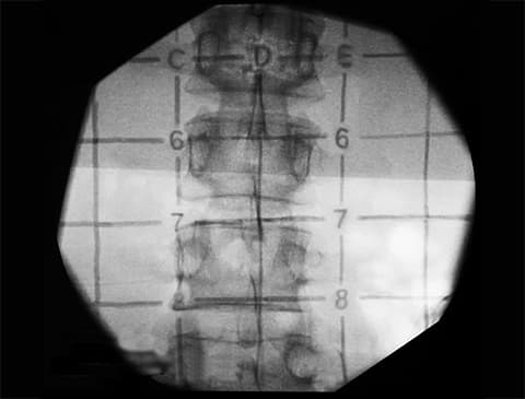 visão da fluoroscopia do x-grid matriz radiopaca do kit cânula safe block para bloqueio de nervos