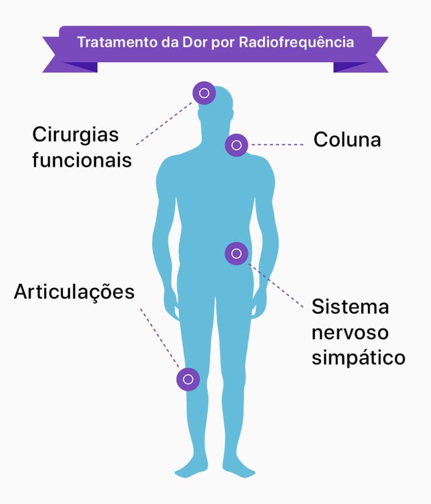 tratamento da dor radiofrequência: cirurgias funcionais, coluna, articulações e sistema nervoso simpático