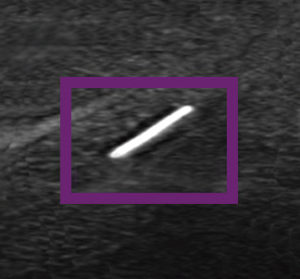 Visão da cânula pela ultrassom pela ponta ecogênica