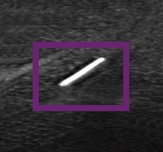 Visão da cânula pela ultrassom pela ponta ecogênica