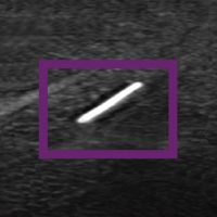 Visão da cânula pela ultrassom pela ponta ecogênica